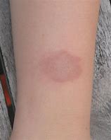 Image result for Circular Rash On Skin