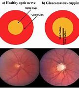 Image result for Enlarged Optic Nerve