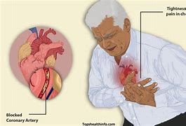 Image result for Angina Pectoris Anatomical Position