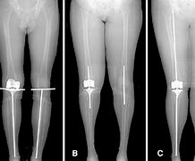 Image result for X-ray of Leg with Metal Plates