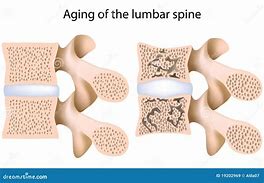 Image result for Osteoporosis Lumbar Spine