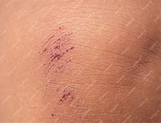 Image result for Knee Scab