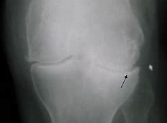 Image result for Patellofemoral Joint Space Narrowing