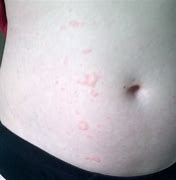 Image result for Rash Caused by Detergent