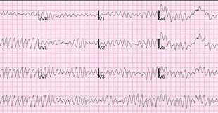 Image result for Atrial Fibrillation 12 Lead ECG