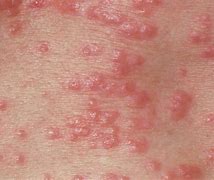 Image result for Pustule Rashes