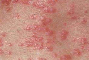 Image result for Skin Rash with Pustules