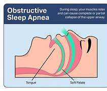 Image result for Sleep Apnea Treatment