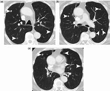 Image result for Lung Window CT