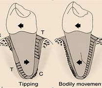 Image result for Propel Tooth Movement