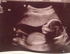 Image result for 4D Ultrasound at 15 Weeks