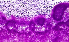 Image result for Actinomycetoma