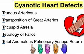 Image result for Cyanotic Heart Defect