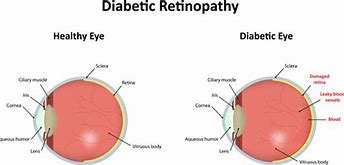 Image result for Red Spot On Eye