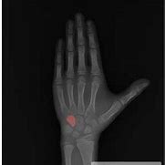 Image result for hamate bone x-ray