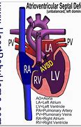 Image result for Tof with Atrioventricular Canal Defect