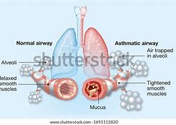 Image result for Lungs of a Person with Asthma