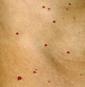 Image result for Dark Red Spots On Skin