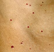 Image result for Red Flat Skin Lesion