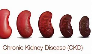 Image result for Chronic Kidney Disease