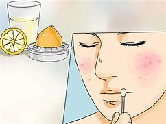 Image result for Pimples to Non Pimples