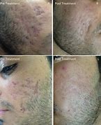 Image result for Atrophic Scar Treatment