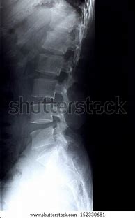 Image result for Lumbar Spine Side View