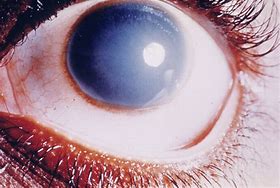 Image result for Corneal Defect