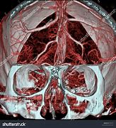 Image result for Brain MRI Angiogram