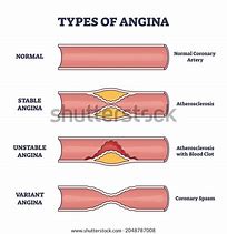 Image result for Stable Angina Pectoris