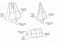 Image result for Propel Tooth Movement