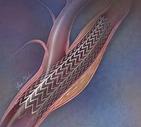 Image result for Carotid Artery Stenting