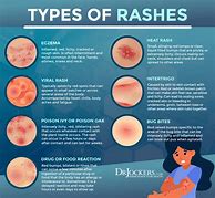 Image result for Skin Rash Identification Chart