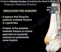 Image result for Posterior Tibial Malleolus