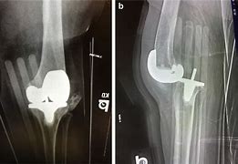 Image result for Left Knee Arthroplasty