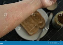 Image result for Peanut Butter Allergy Rash