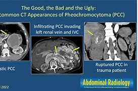 Image result for Pheochromocytoma On CT Scan