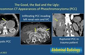 Image result for Large Pheochromocytoma CT