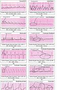 Image result for AFib vs V-fib