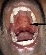 Image result for Candida Throat Infection