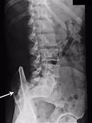 Image result for Lumbar and Sacral Spine