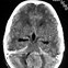 Image result for Medulloblastoma Location Diagram