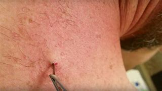 Image result for Ingrown Hair Causing Boils