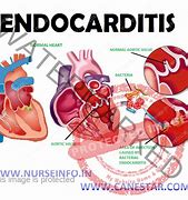 Image result for Acute Endocarditis