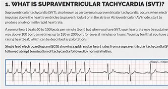 Image result for SVT Cardiology