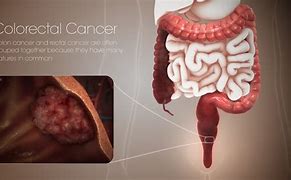 Image result for Cancer De Colon Tac