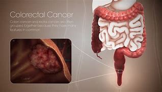 Image result for Pics of Colon Cancer