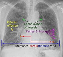 Image result for Acute Pulmonary Oedema Positioning