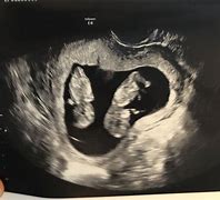 Image result for 11 Week Ultrasound Twins