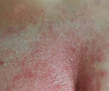 Image result for MSAD Skin